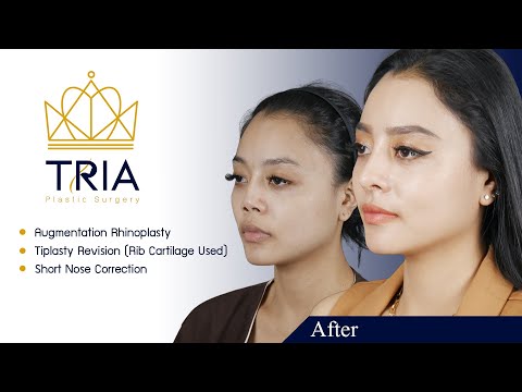 Video: 5 Bintang Teratas Yang Melakukan Rhinoplasty Hidung