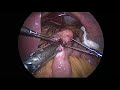 Laparoscopic Mini Gastric Bypass surgery (with voice over)- Dr Vikas Singhal- GI &amp; Bariatric Surgeon