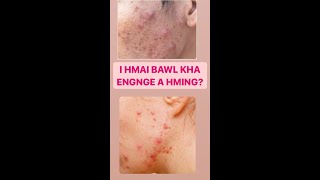 Hmai Bawl Chungchang I Hmai Bawl Nihna Tak Eng Nge? - Subtitledifferent Types Of Acne Skincare