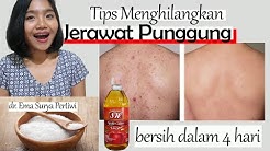 Tips Jerawat Punggung Hilang dalam 4 hari, Murah Meriah - Durasi: 3.50. Tips Jerawat Punggung Hilang dalam 4 hari, Murah Meriah - Durasi: 3.50.