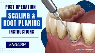 Post-op Instructions - Scaling and Root Planing - English