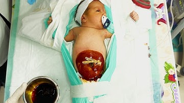 🚨 Emergency Exchange Transfusion in 3-Day-Old Baby | Real NICU Procedure (Severe Hyperbilirubinemia)