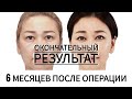 6 МЕСЯЦЕВ ПОСЛЕ ОПЕРАЦИИ: ОКОНЧАТЕЛЬНЫЙ РЕЗУЛЬТАТ. JW Plastic Surgery