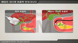 [시연용]b0044aako_[축약판]췌담도내시경초음파(EUS) 안내
