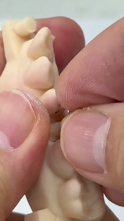 The best tooth retentions!