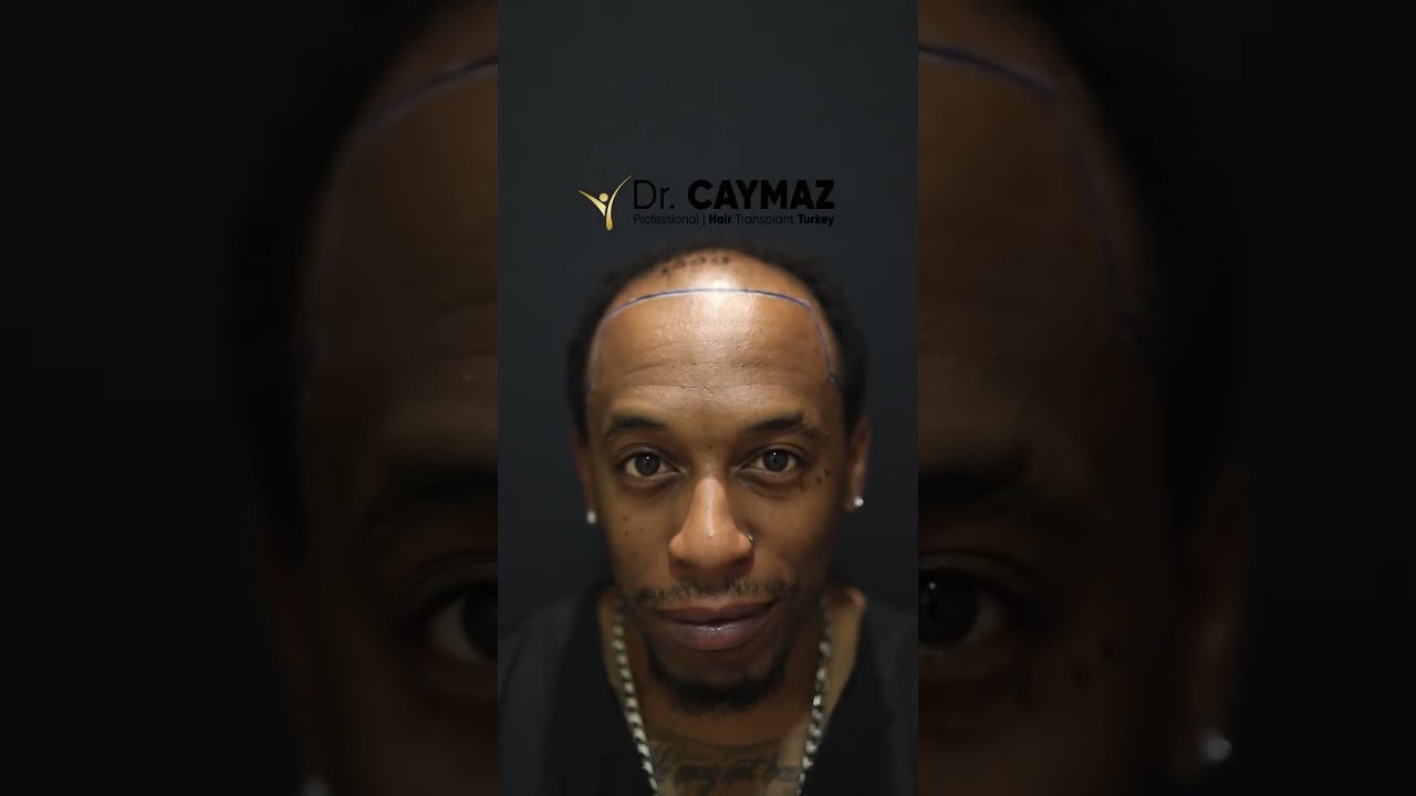 M Lee 4500 Graft 6,5 Months - Dr. Caymaz