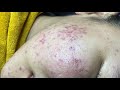 Inflamatory acne causes painful  va p2 hoangmyspa102