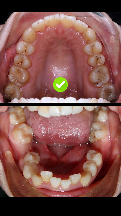 Missing teeth do not prevent you from getting braces