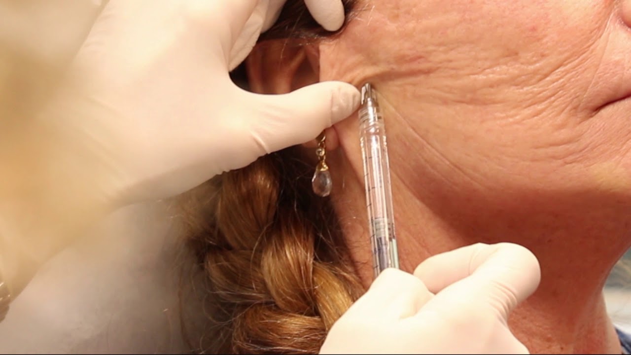Banner for Picket Fence Injections on the Jawline with Dr. Butterwick