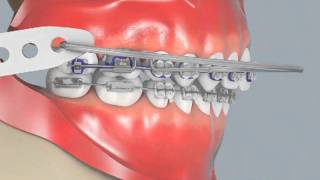 Cervical Headgear