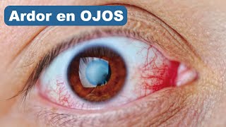 👁️🔥 ¿POR QUÉ ARDEN TUS OJOS? Causas y soluciones