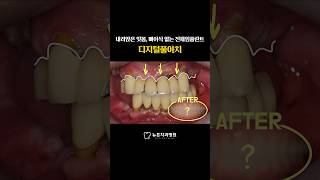 [부산디지털풀아치] 내려앉은 잇몸, 뼈이식 없는 전체임플란트 &quot;디지털풀아치&quot;  #shorts