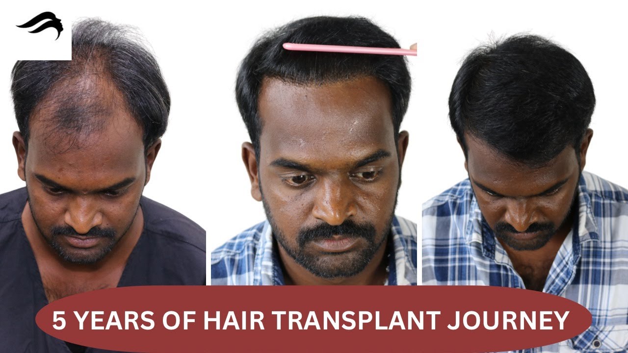 Best Hair Transplant in Thiruvananthapuram Top Hair Transplant Surgeon in  Thiruvananthapuram