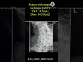 How to take Radiograph of Vertebral Arch (Pillars) AP Axial Oblique Projection #spine #radiographer