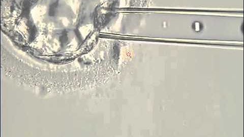 Preimplantation Genetic Diagnosis (PGD): Five Day Biopsy