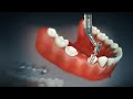 Dental bridge and crown  fixed bridge  fixed dental replacement