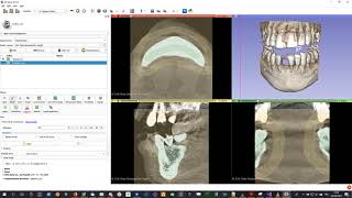Tutorial: How To Create STL segmentation from DICOM using 3D Slicer (Virteasy Dental / Editor)
