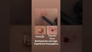 Extirpación sin dolor: Verrugas Papillomas Queratomas  Удаление без боли Бородавок Папиллом Родинок