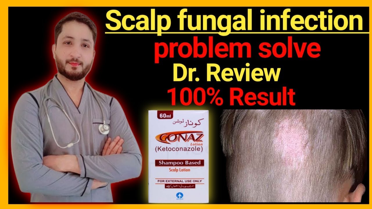 Hair fungal infection treatment scalp fungal injection problem solve