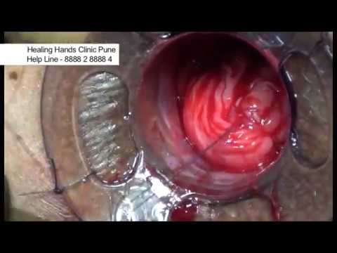 hernia treatment non surgical Female STARR Surgery in India | Healing Hands Clinic