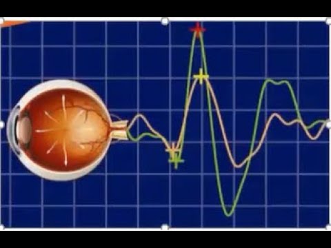 تخطيط الشبكية وتخطيط العصب البصري. (ERG/VEP)