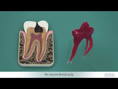 Video: Endodontilise ravi ajal niisutatakse pulpaalkanaleid?