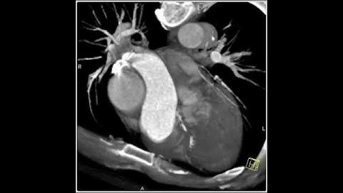 4D Imaging of the Aortic Valve: Dilated aortic root (4 of 6)