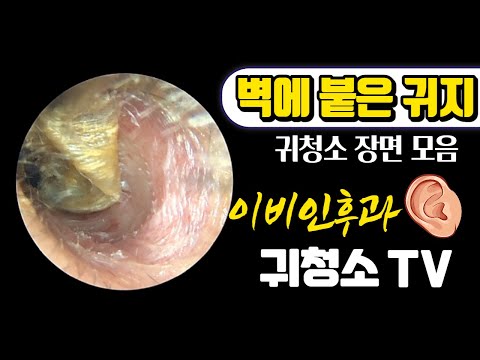 벽에 붙은 귀지 제거 (cerumen removal) 귀청소 장면 모음