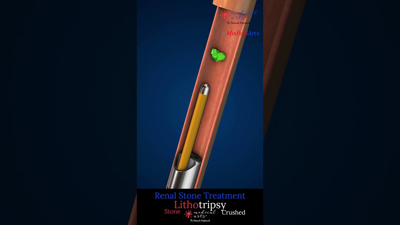 How Doctors Remove Kidney Stones Without Surgery Lithotripsy Demonstrated 