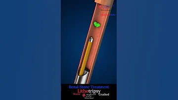 How Doctors Remove Kidney Stones Without Surgery Lithotripsy Demonstrated 