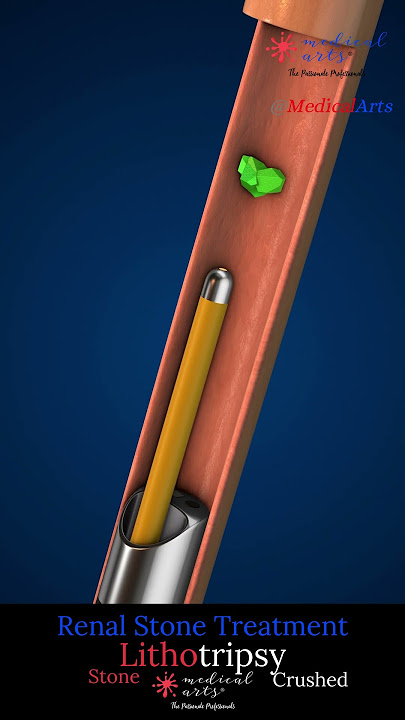How Doctors Remove Kidney Stones Without Surgery! (Lithotripsy demonstrated)