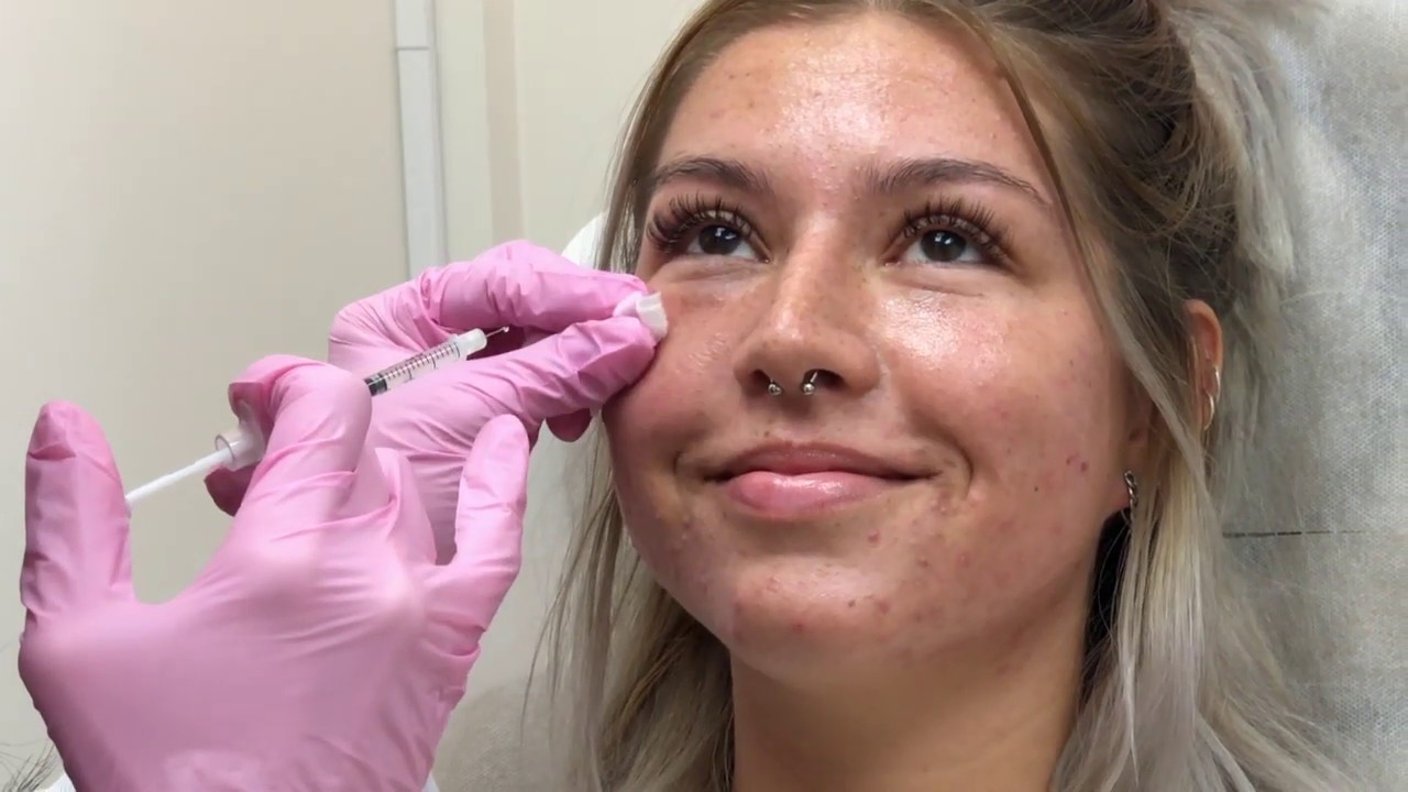 Fillers and White Blood Cells 