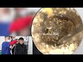 💤 耳かき | 耳掃除 | 大きくて硬い耳垢。| DR. LAI MINH TUAN