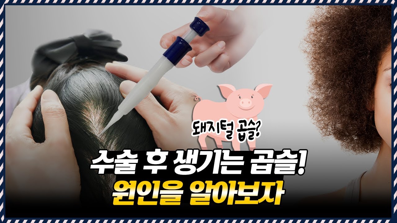 의느님답변📂꼬불꼬불 곱슬머리🤦♂️모낭을 깊게 심으면 나타난다고!?ㅣ다나성형외과(DANA)ㅣ모발이식ㅣ헤어라인교정ㅣ두피문신ㅣ탈모치료