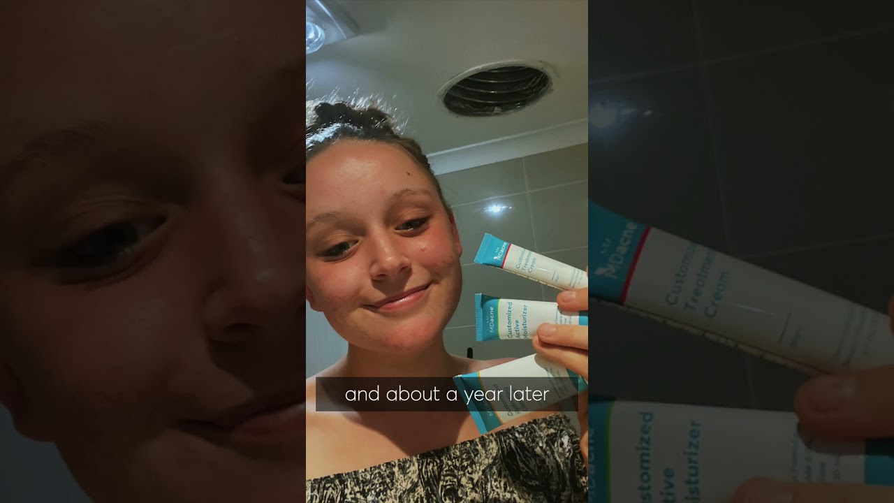 How I cleared my acne!