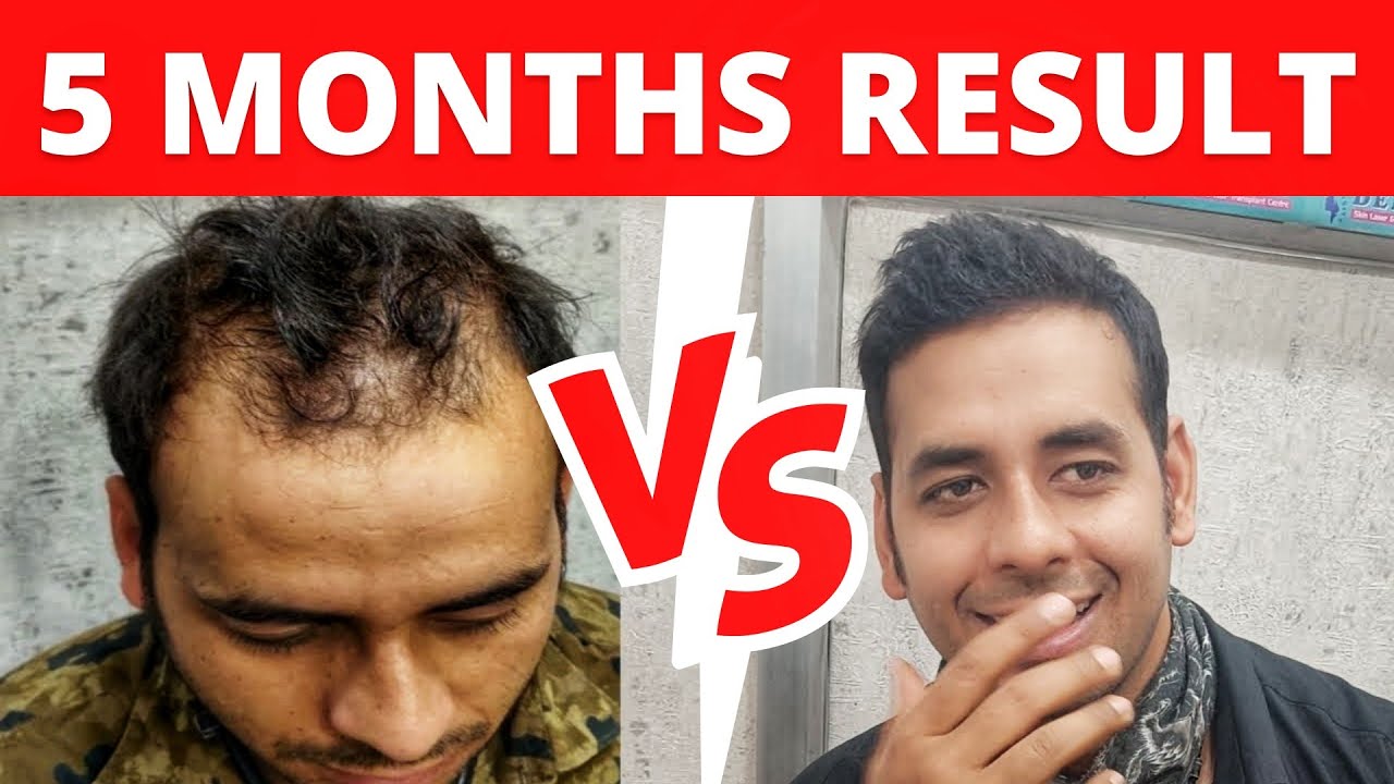 Hair Transplant Results, 5 Months Before And After || Density Hair  Transplant Centre Ranchi, Patna - YouTube
