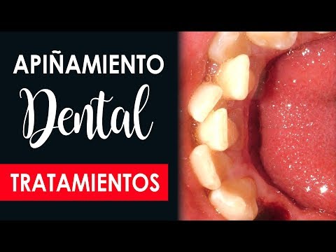 Vídeo: ¿Qué Es El Arnés De Ortodoncia Y Cómo Ayuda A Enderezar Los Dientes?
