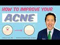 How to Cure Your Acne - Dr. Anthony Youn