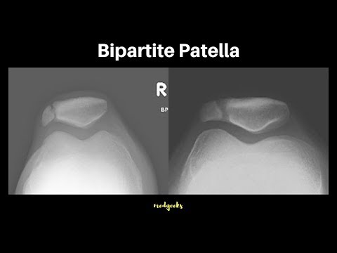 Video: Bipartitt-patella: Symptomer, årsaker Og Behandling