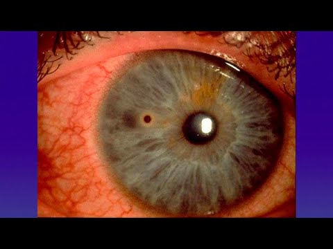 ¿Qué hacer ante una emergencia ocular?