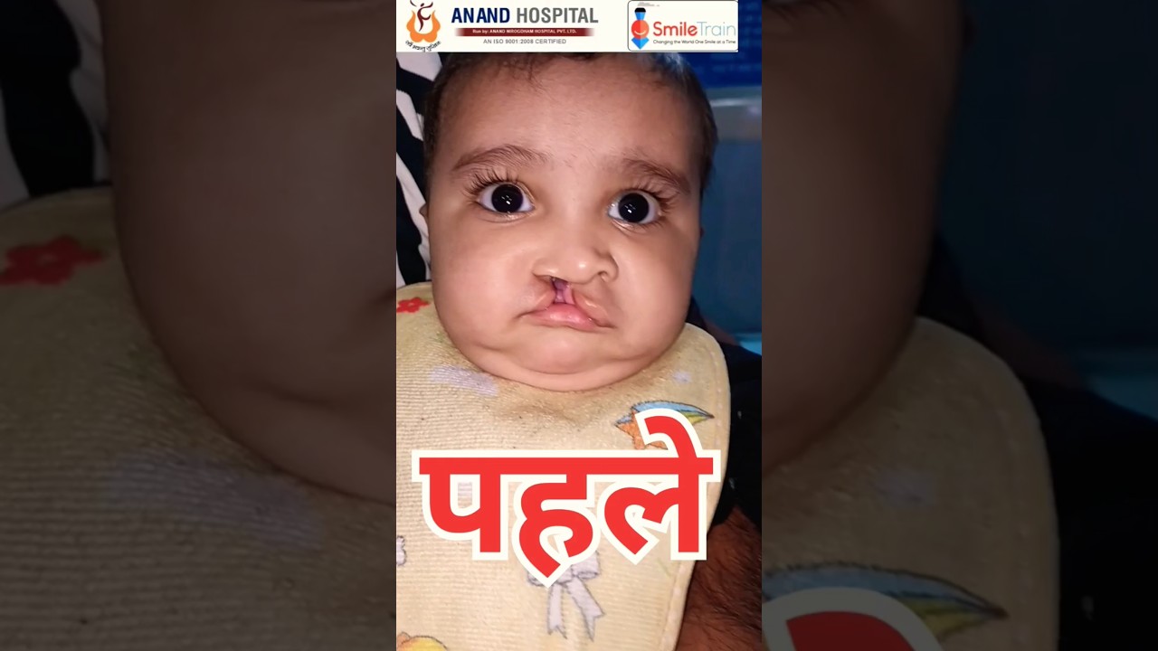 !!Cleft Lip and palate 