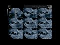 Lower uterine segment Cesarean section - Post-Cesarean delivery niche -ISUOG education course