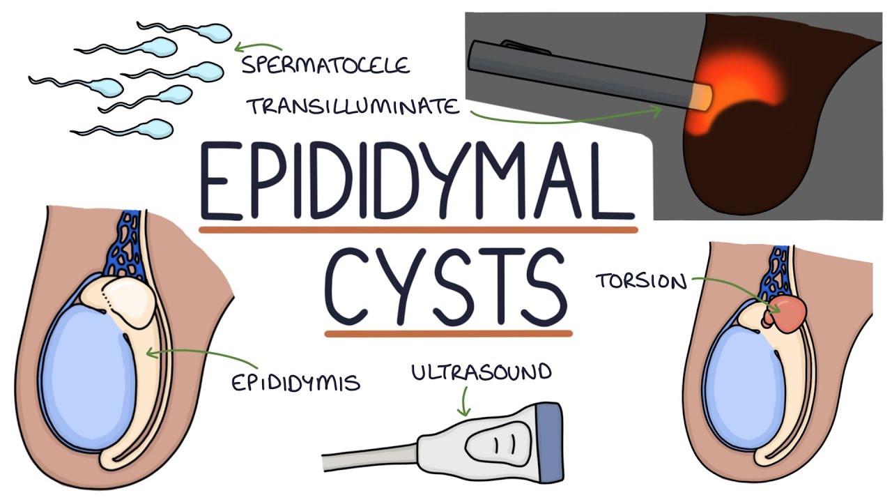 blandt ozon budbringer Understanding Epididymal Cysts - YouTube