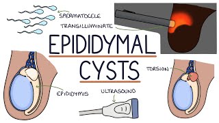 Understanding Epididymal Cysts