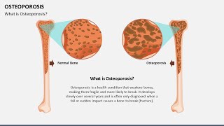 Osteoporosis Animated PowerPoint Template