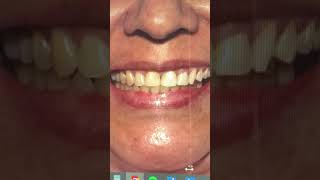 ¿Como quedará mi diseño de sonrisas? #software #dentalclinic