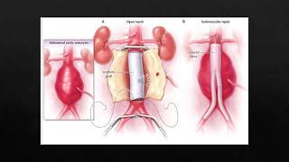 Abdominal Aortic Aneurysm case study