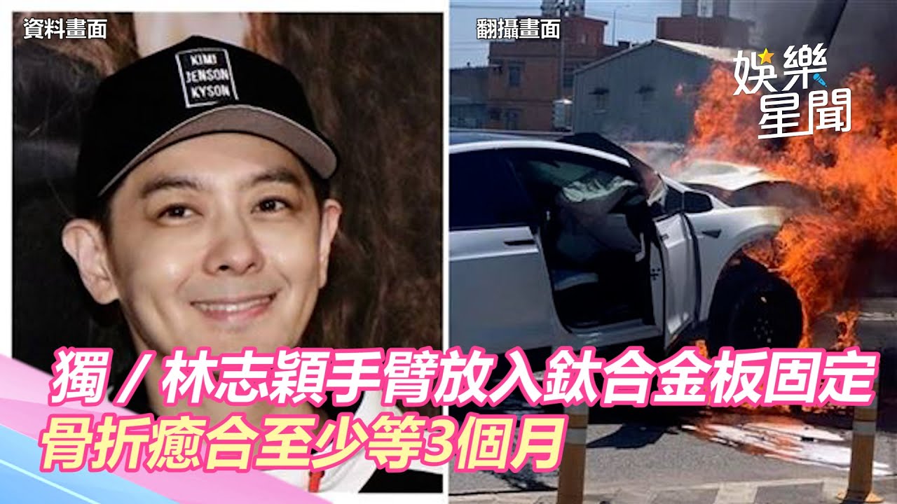 獨／林志穎手臂放入鈦合金板固定　骨折癒合至少等3個月｜三立新聞網 SETN.com