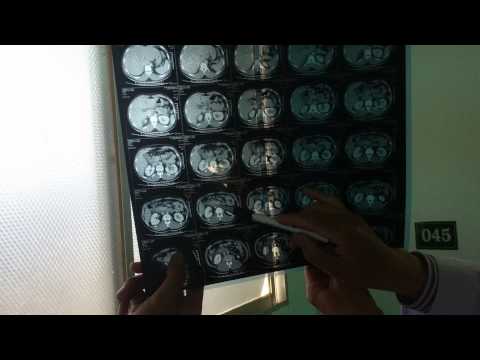 Video Viêm ruột thừa hay viêm tụy cấp - youtube