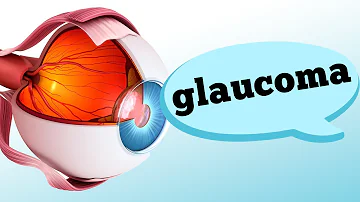 ¿Qué se considera glaucoma grave?